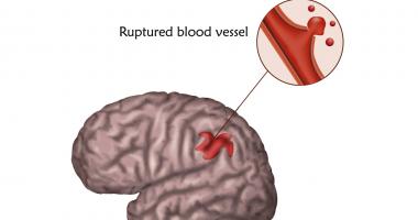 Diagrama del accidente cerebrovascular (ACV) hemorrágico