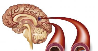 Diagrama del accidente cerebrovascular (ACV) isquémico