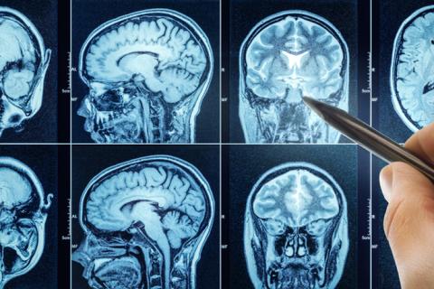 Escáner de cerebro que muestra el síndrome de Wernicke-Korsakoff.