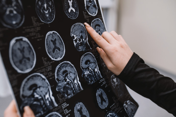 Radiografía del cerebro para analizar los avances en la esclerosis múltiple.