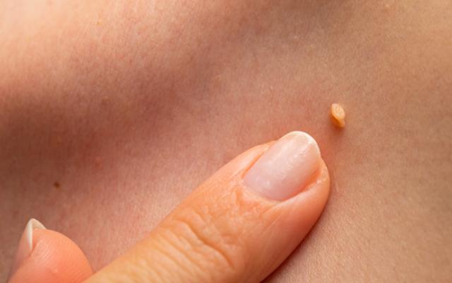 Persona que se pregunta cómo fortalecer el sistema inmunológico para eliminar el VPH.